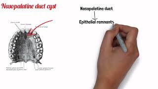 FISSURAL CYSTS  ORAL PATHOLOGY [upl. by Ayifas]