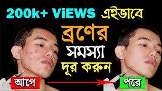 ব্রণ দূর করার উপায়  Mukher kalo dag dur korar upay  How to Remove Pimples or Acne [upl. by Asylem]