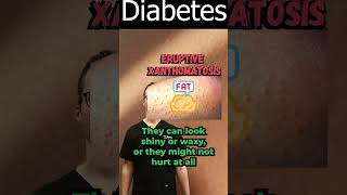 Eruptive Xanthomatosis Pictures amp Treatment Diabetes amp Diagnosis [upl. by Stacie]