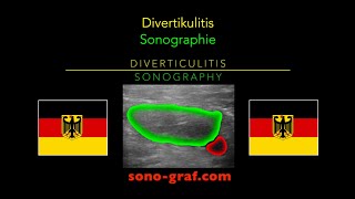 Sonographie  Divertikulitis [upl. by Ajat]