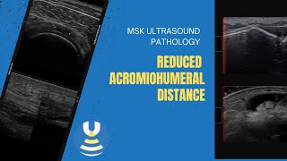 Reduced acromiohumeral distance visualised on shoulder ultrasound [upl. by Curson]