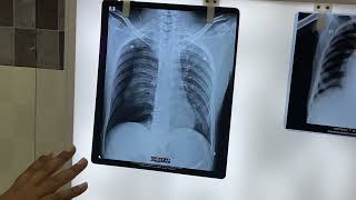 Pneumothorax Vs Pleural effusion [upl. by Inaffit]