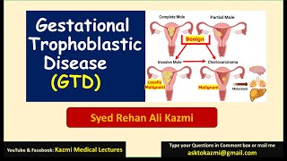 Gestational Trophoblastic Disease  Molar pregnancy  Obstetric review  KML [upl. by Viking]