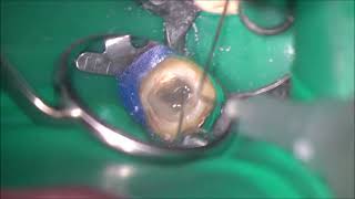 Complete removal of contaminated guttapercha from the Cshaped root canal using ultrasonic device [upl. by Ameen]