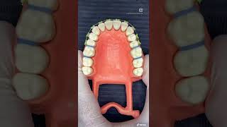 INSTALACIÓN de Expansor dentalHYRAX [upl. by Eselahc]