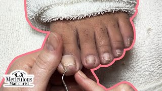 How to Trim Nails with Ingrown Toenail Discomfort and Deep Nail Grooves [upl. by Ellehsor]