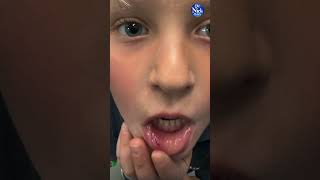 LASER Excisonal BIOPSY on a 6 Year Old lightwalker laser dentist dentistry [upl. by Kannry382]