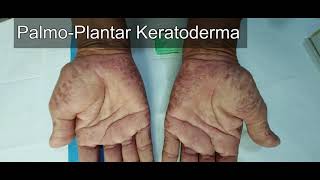 Palmoplantar Keratoderma [upl. by Ahtiekahs]