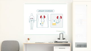 Bladder Cancer Treatment Urinary Diversion  Urology Care Foundation [upl. by Notneuq]