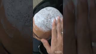 HEAD WASH SCAB REMOVAL hairtransplant headwash drirfanshaikh AlkhaleejClinics Karachi [upl. by Bena950]