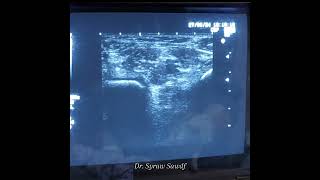 Sciatic nerve block at popliteal fossa for heel surgery by Dr Sairah Sadaf [upl. by Akeenat]