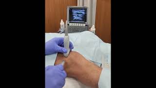 PRP knee injection under ultrasound guidance [upl. by Nibbs576]