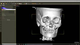 3D Orthognathic Planning with DDSPro [upl. by Miyasawa995]