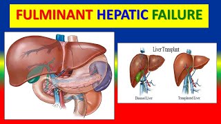 FULMINANT HEPATIC FAILURE [upl. by Aicnelev333]