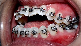 Chỉnh răng cắn hở  Orthodontic openbite teeth [upl. by Enutrof429]