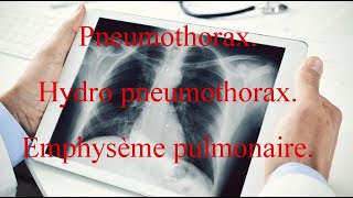 Pneumothorax  Hydro pneumothorax  Emphysème pulmonaire [upl. by Drue]