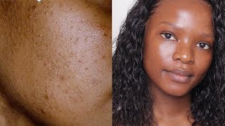 HOW I CLEARED MY SKIN  DARK SPOTS MILD ACNE AND HYPERPIGMENTATION [upl. by Haldane316]