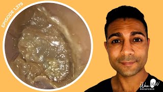 1379  Long Procedure to Treat Complex Outer Ear Fungal Infection [upl. by Zulch13]