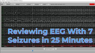 EEG with 7 seizures in 25 minutes [upl. by Pressey]