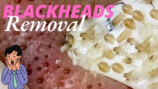 Blackheads Extraction 😲 blackheads problem satisfying blackheads blackheadremoval [upl. by Simsar]