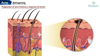 Acne Animation Introduction Pathogenesis Types of Acne Treatment and Prevention of Acne [upl. by Parsaye]