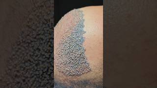 Vinci Hairs natural hair transplant post op transition vincihairclinic shorts [upl. by Yttam]