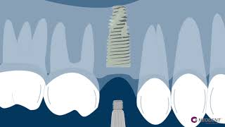 Single Implant  Neodent by Straumann [upl. by Cioban]