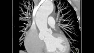 Cardiac Dilated aortic root and sinuses of Valsalva 1 of 10 [upl. by Llenrev]