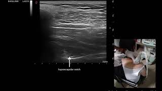 suprascapular nerve block [upl. by Fergus288]