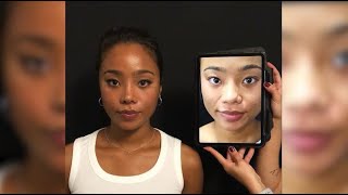 Ethnic Rhinoplasty Surgery in Turkey By Dr Bora Ok  Post Op 5 Days  BeforeAfter [upl. by Terrag833]