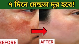 মেছতা দূর করার বৈজ্ঞানিক উপায়।। মেছতা দূর করার ঘরোয়া উপায়। MelasmaHow to treat melasma [upl. by Nnaeel119]