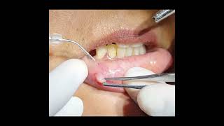 Fibroma Excision using Diode Laser Dr Ankit Goel Hapur [upl. by Monica]