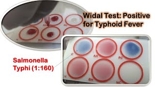 Widal Test Positive Demonstration [upl. by Abbye]