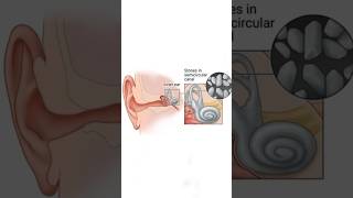 Benign paroxysmal positional vertigo [upl. by Chipman]