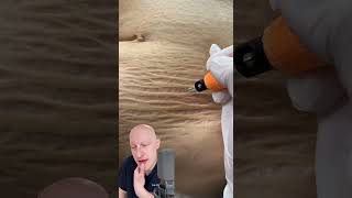 Plasma Pen As A Cure For Stretchmarks  Doctor Reacts [upl. by Aylatan]