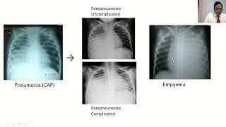 EmpyemaParapnemonic Effusions [upl. by Siletotsira]