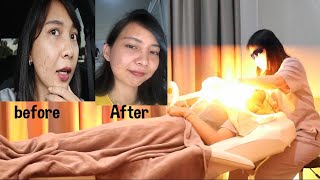 Part 2  IPL Face Rejuvenation di glowderma [upl. by Aicile160]