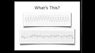 ECG Heart Rhythm Review [upl. by Anitac]