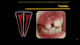 quot¿Sabes cómo interpretar las alteraciones en la morfología de las piezas dentariasquot [upl. by Ano921]