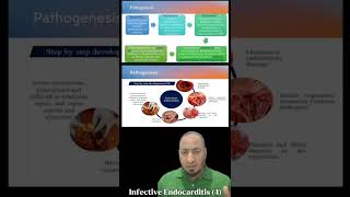 Infective Endocarditis 4 pathogenesis التهاب الشغاف المعدي microbiology medicalstudent [upl. by Checani]