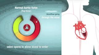 Valve Stenosis When a Heart Valve is Too Narrow [upl. by Ataynik846]