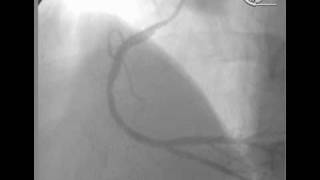 angioplastia en Infarto Agudo [upl. by Eul]