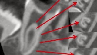 Case report of a Cshaped root canal treated by the SAF System [upl. by Anoyi713]