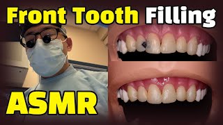 How to fix cavities between front teeth  Dental ASMR Composite Resin Filling Procedure Explained [upl. by Kikelia773]