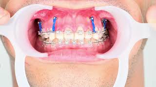 Surgery free gummysmile correction by connecting braces to tads [upl. by Kensell]