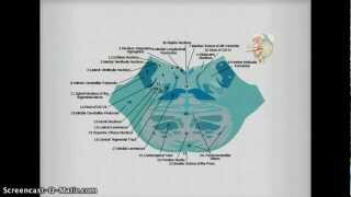 Medial Inferior Pontine Syndrome pics [upl. by Efron714]