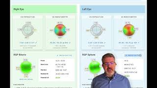 EyeDocks New Contact Lens Calculator Abridged Video [upl. by Tiphany]