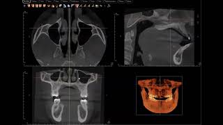 Hypoplastic maxillary sinus CBCT [upl. by Bronson]