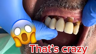 Crwons and teeth removing 😱CRAZY video 🤢🤢 [upl. by Adnovoj357]