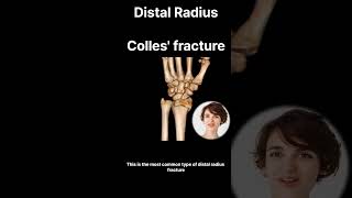 Breaking Down Colles Fracture Understanding Wrist Bone Breaks [upl. by Ynez]